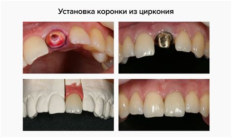 Фиксация чаши на каркасе