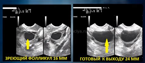 Фолликул 28 мм: причины и последствия его лопнутого состояния