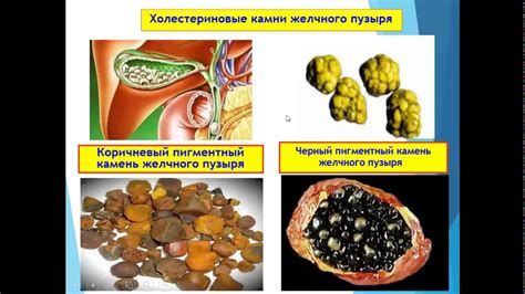 Холецистэктомия: последняя мера при наличии камней желчного пузыря