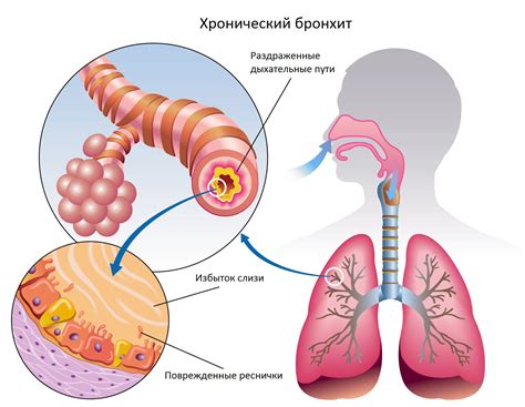 Хронический бронхит