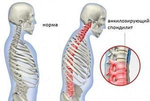 Цервикальный спондилит и подагра