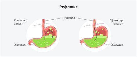 Что вызывает выброс желчи в пищевод?