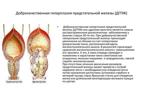 Что вызывает увеличение предстательной железы?