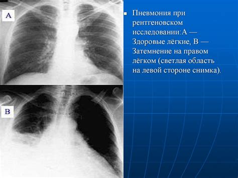 Что показывает флюорографический снимок при пневмонии