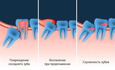 Что такое ЖТ и почему нужно его удалять?