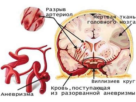 Что такое аневризма головного мозга