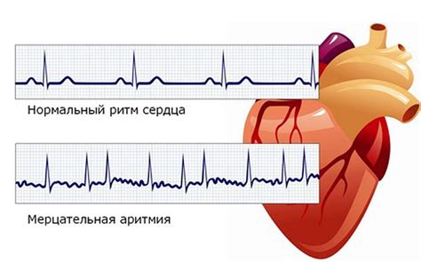 Что такое аритмия в положении лежа?