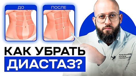 Что такое диастаз прямых мышц живота и как его убрать