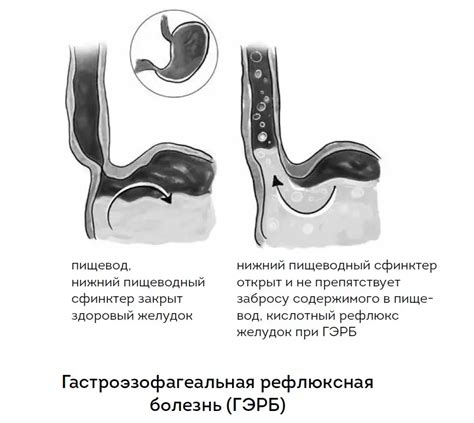 Что такое изжога и почему она возникает