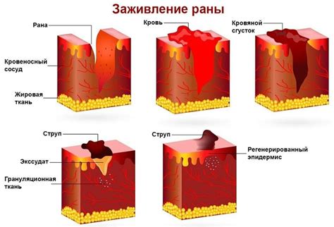 Что такое келоидный рубец?