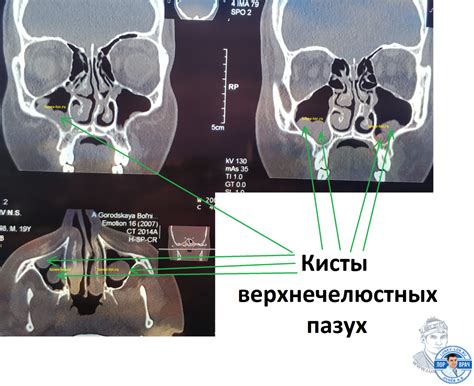 Что такое киста верхнечелюстной пазухи и как ее удаляют: методы и процедуры