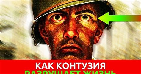 Что такое контузия и какие у нее симптомы?