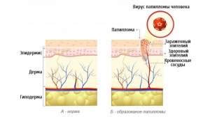 Что такое папилломы и почему они появляются на веках