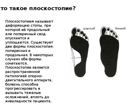 Что такое плоскостопие и может ли оно вызывать боль в ступне?