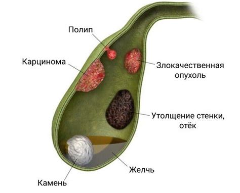 Что такое полипы желчного пузыря?