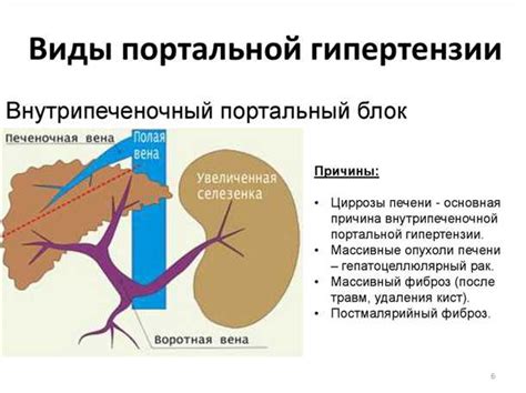 Что такое портальная гипертензия