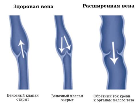 Что такое расширение таза?