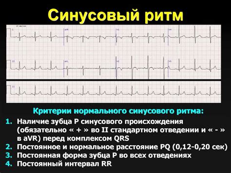 Что такое ритм на ЭКГ?