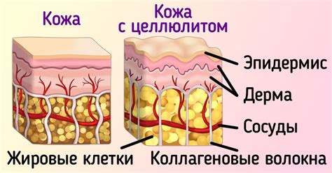 Что такое целлюлит и как он образуется