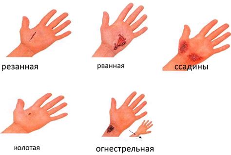 Шаг 4 - Уход за ожоговым местом на протяжении всего процесса заживления