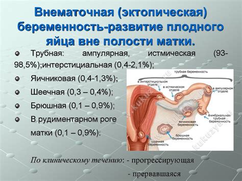 Эктопическая беременность