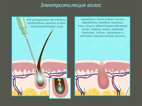 Электроэпиляция: надежное удаление волос на корню