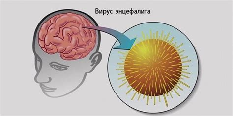 Энцефалит: симптомы, причины, профилактика