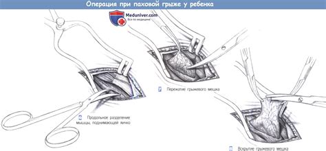 Этапы операции при грыже