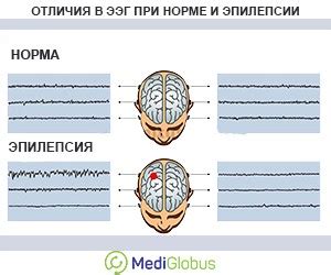 Этапы проведения ЭЭГ при ОРВИ