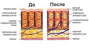 Эффективность антицеллюлитного массажа