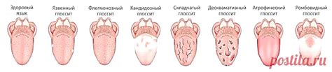 Эффективные методы лечения стоматита на языке