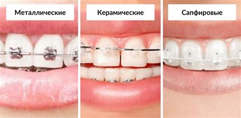 Эффекты использования брекет-системы