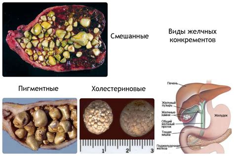 Яичко и камни в желчном пузыре