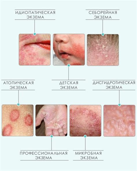  Дерматит и экзема 