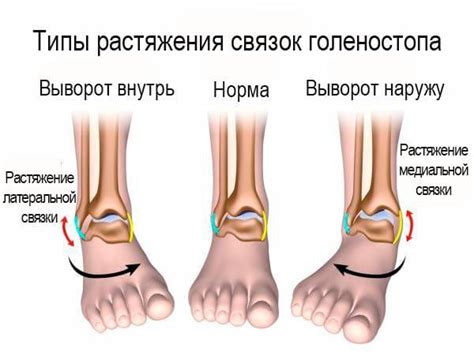  Как вернуть гибкость голеностопа после растяжения связок 