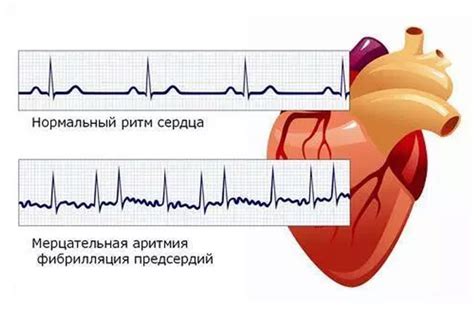  Мерцательная аритмия: что это? 