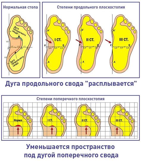  Плоскостопие и ожирение 