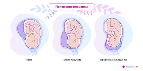  Что такое низкая плацентация 