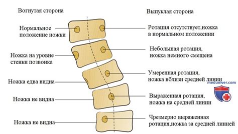 5 способов коррекции искривления назад у ребенка